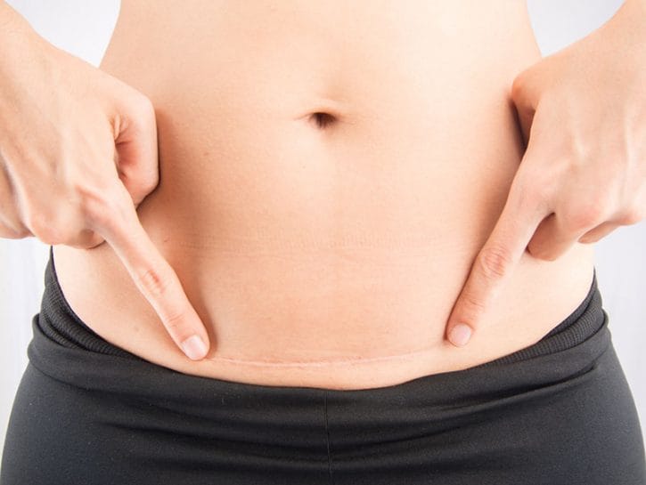 gravidanza dopo cesareo